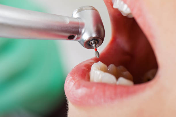 Best Emergency Treatment for Dental Infections or Abscesses in Vienna Bend, LA